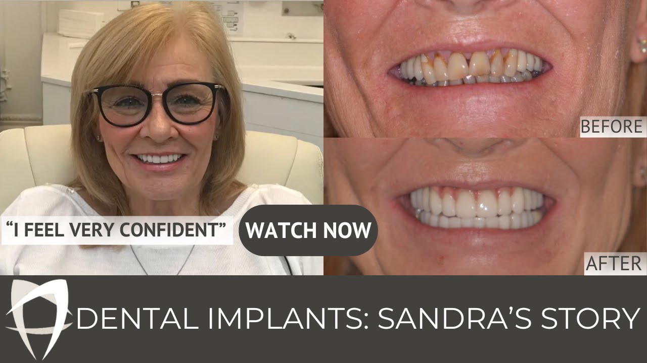 Sandra - All-on-6 Upper and All-on-4 Lower