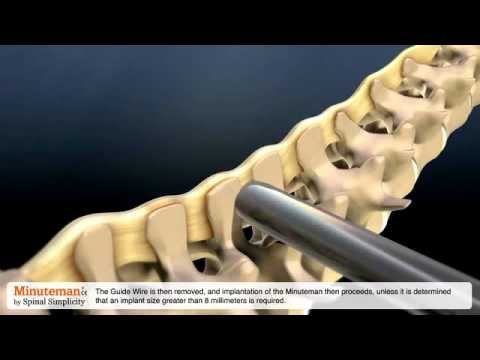 Osteocondrosi del collo è molto dolorante Pomata per lartrite del ginocchio