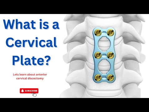 Cervical Plate & ACDF by Dr. Ajay Kothari