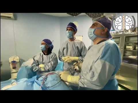 Third ventricular endoscopic ventriculostomy (ETV)