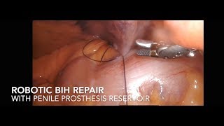 Download lagu Robotic BIH mesh with  Penile prosthesis mp3