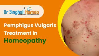 Best Homeopathic Treatment for Pemphigus Vulgaris