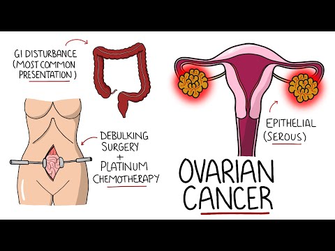 Ovarian Cancer Explained Including Subtypes
