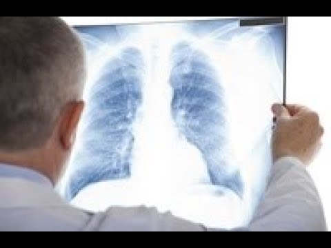 , title : 'Sarkoidoza – choroba autoagresywna charakteryzująca się ziarnami w płucach'