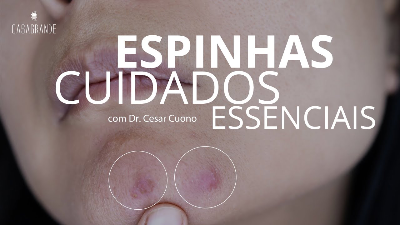 Cuidados essenciais para quem tem espinhas e pele oleosa