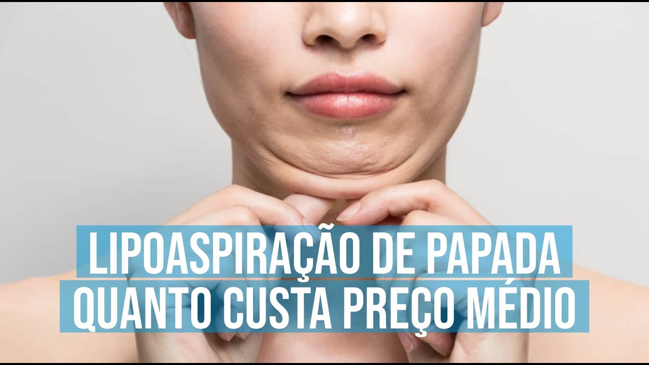 Watch Now Lipoaspiração de Papada: Quanto Custa, Preço da Sessão Lipoaspiração de Papada: Quanto Custa, Preço da Sessão
