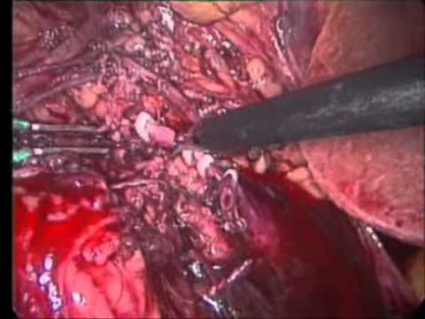 The Renal Hilum - The Use Of Polymer Clips