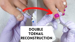 Double Toenail Reconstruction With LCN Barefoot Gel And Gehwol Nail Repair Gel!