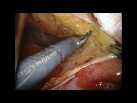 Robotic Surgery Over Laparoscopy Surgery