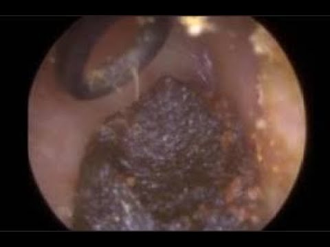 Jobson Horne Removal of Ear Wax from Entire Ear Canal