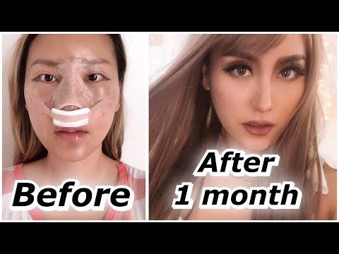 Rhinoplasty 1 month update BEFORE & AFTER | ID Hospital Surgery PART 2