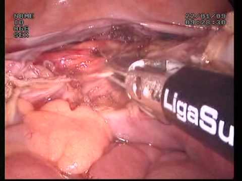 Laparoscopic Uterus Removal Via Umbilicus With A Ligasure Tool Use