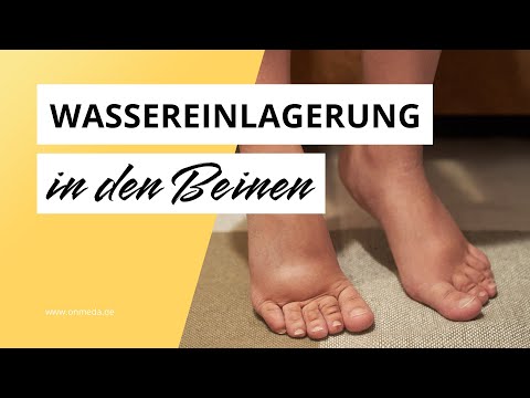Ab wann ist Wasser in den Beinen gefährlich?