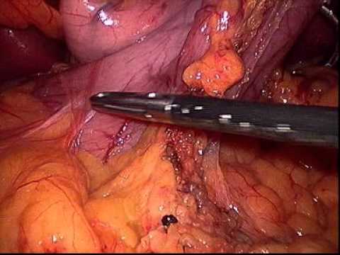 Sleeve Gastrectomy in Macronoduloar Cirrhosis