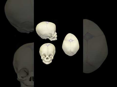 Congenital skull abnormalities (craniosynostosis) #skull #skulldeformity #flathead @fauquierent
