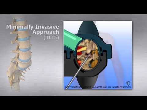 Lumbar Minimally Invasive Approach TLIF