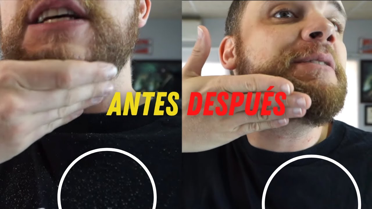 Watch ¿CÓMO QUITAR LA CASPA DE LA BARBA // DESCAMACIÓN EN LA BARBA Now ¿CÓMO QUITAR LA CASPA DE LA BARBA // DESCAMACIÓN EN LA BARBA