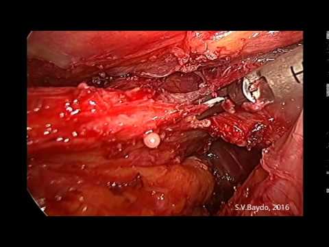 Escisión mesorrectal total (TME) laparoscópica 