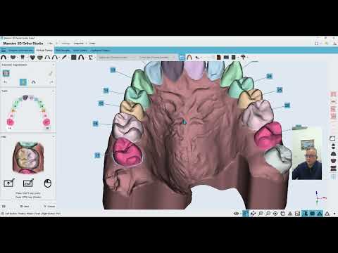 In-house Aligners and DIY solutions - Part 3