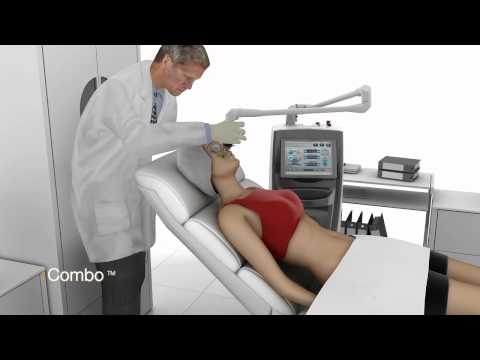 Lumenis AcuPulse - לומניס