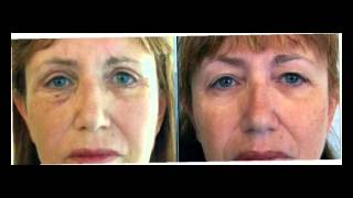 ד"ר אבישי וינברגר - תמונות לפני ואחרי ניתוח עפעפיים