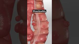 Diverticulitis (3D Animation)