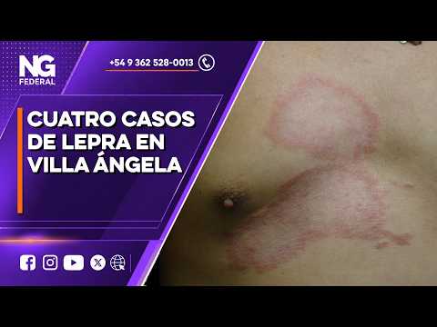 NG FEDERAL - CUATRO CASOS DE LEPRA EN VILLA ÁNGELA - CHACO