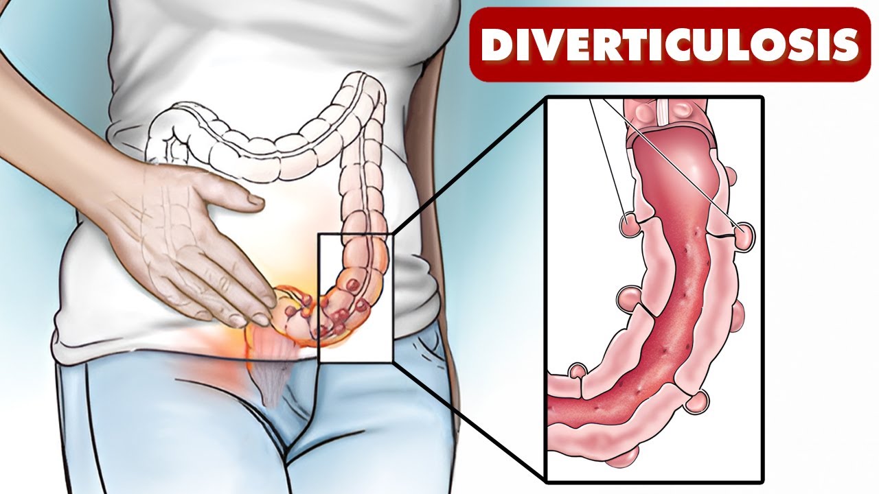 Understanding Diverticulosis and Diverticulitis-Doctor Explains