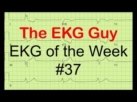 EKG/ECG of the Week #37 | The EKG Guy - www.ekg.md