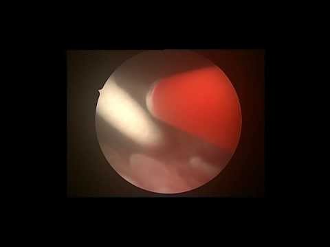 KIDNEY STONE LASER