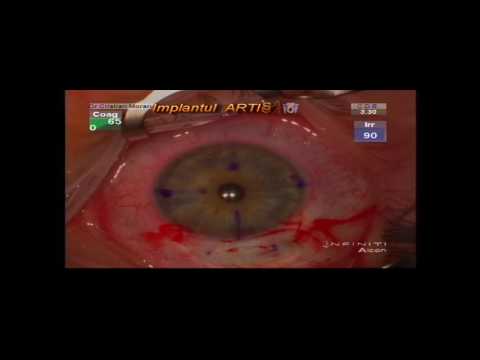 Cum se restabilește cataracta vederii