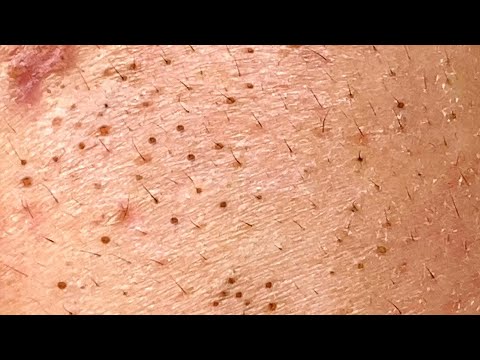 NEXT LEVEL BLACKHEAD REMOVAL – It Just Kept Coming!
