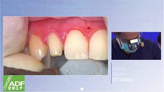 SUPERTRACT : HEMOSTASE ET RETRACTION