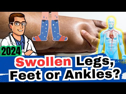 , title : '#1 Cause of Swollen Ankles, Legs or Feet? [What Causes It, Dangers?]'