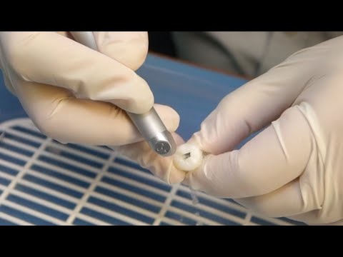 Caries Removal with LIGHTMED's SAPPHIRE Laser