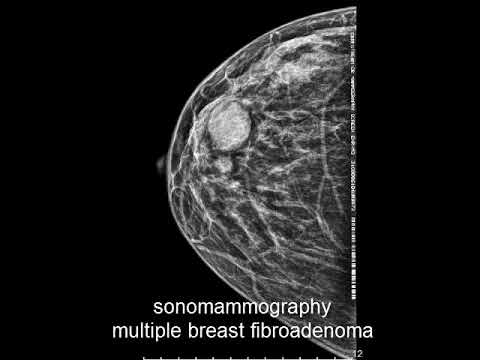 Sonomammographie - Fibroadénome mammaire multiple