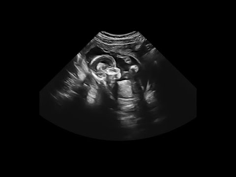 Then there were 3...