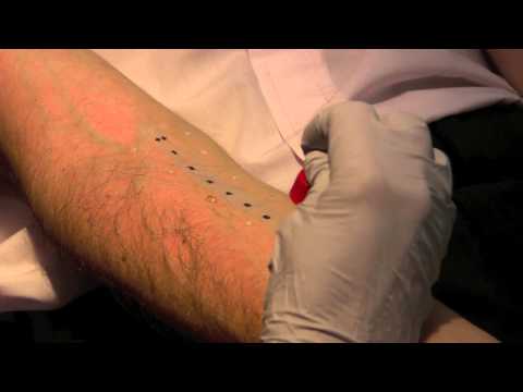 Skin Prick Allergy Test