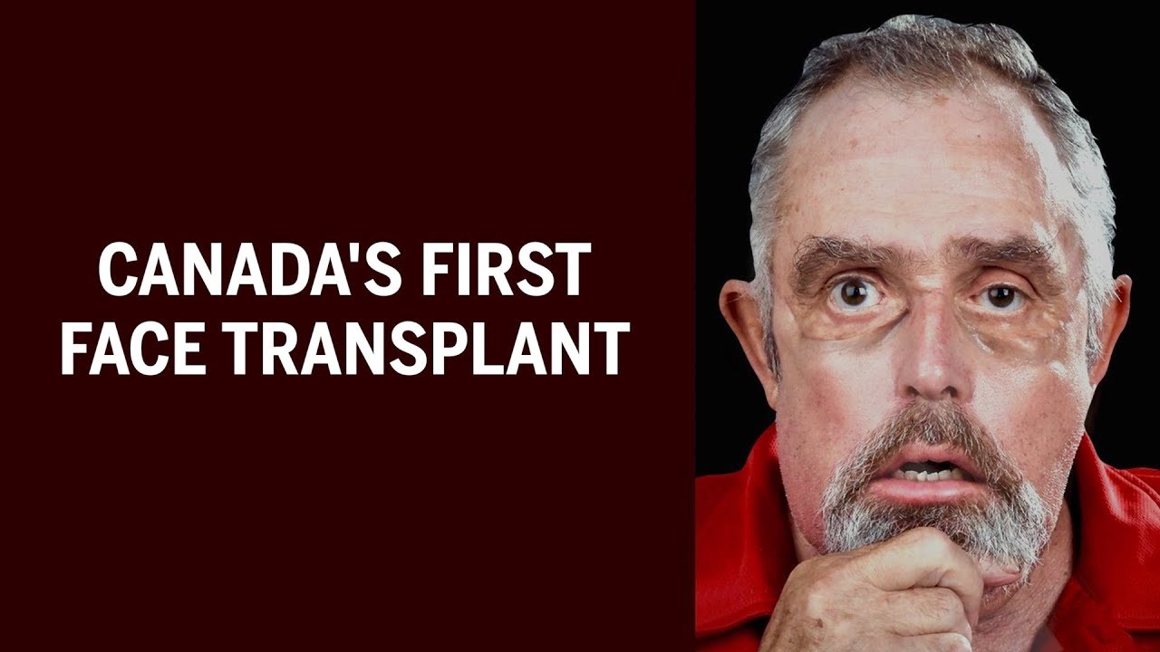 The story behind Canada's first face transplant thumnail