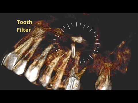 Localization of Retained Roots Inside Maxillary Sinus