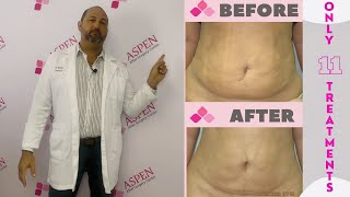 Liposuction Fibrosis Treatment- Soften and Smooth Lumps and Bumps