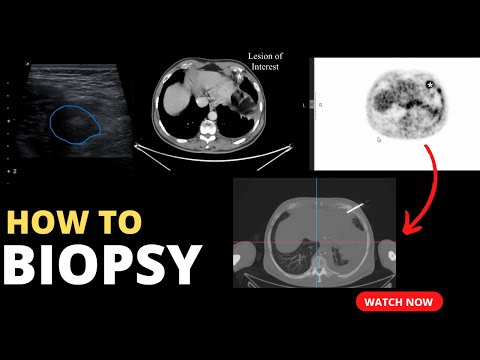 HOW TO - Image Guided Percutaneous Biopsy: PET-CT, USG, and CT