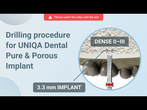 Drilling procedure for UNIQA Dental Pure & Porous Implant UH8 UV11 [ 3.3 mm | D2-D3 bone density ]