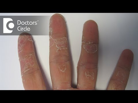 Causes of dry, affected small skin patch on hand - Dr. Aruna Prasad