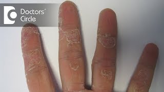 Causes of dry, affected small skin patch on hand - Dr. Aruna Prasad