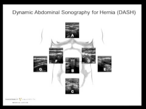 Introduction to hernia outcomes and clinical quality improvement: application to hernia disease