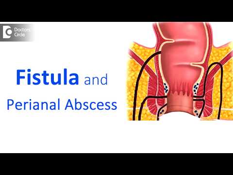 What is fistula? - Dr. Parameshwara C M
