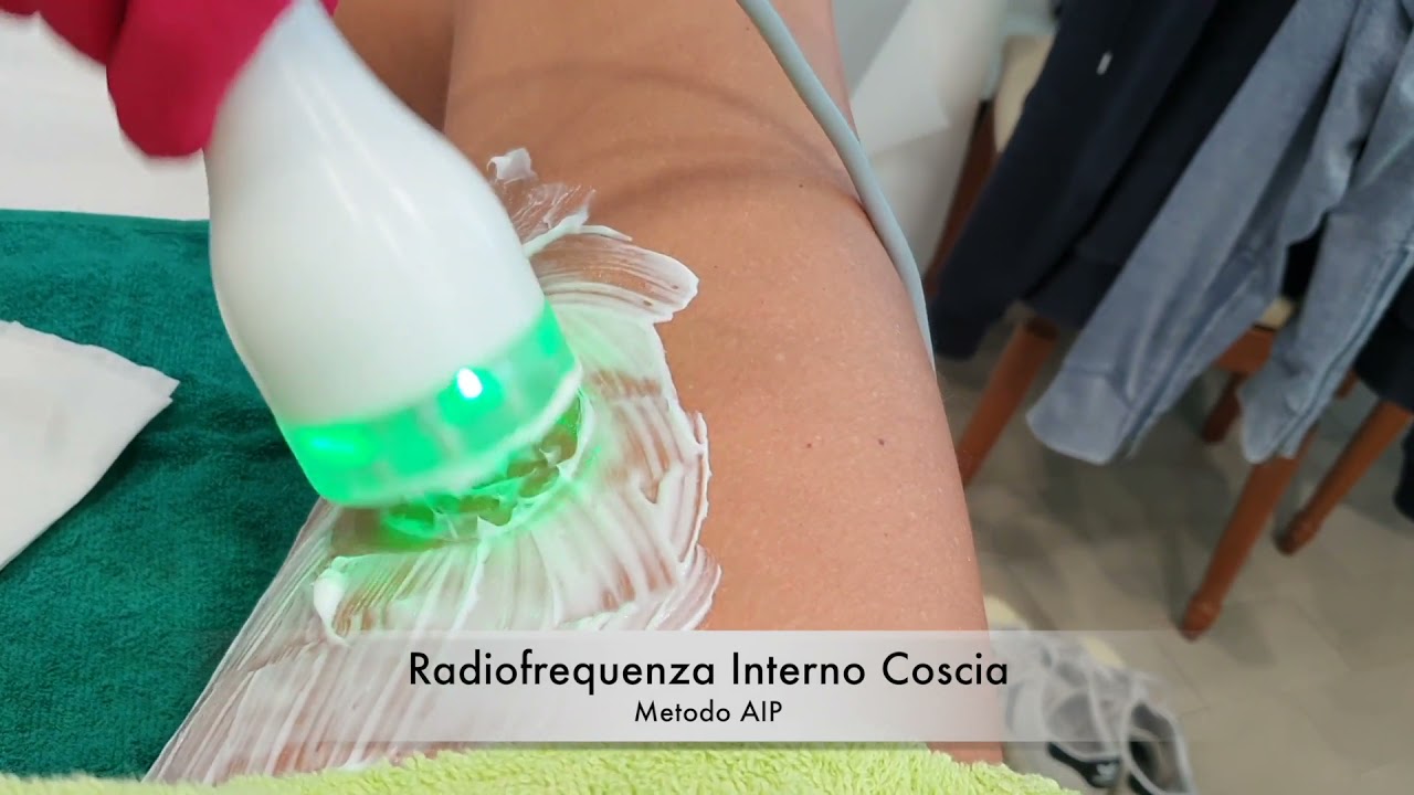 Watch Now Radiofrequenza Interno Coscia - Metodo AIP Radiofrequenza Interno Coscia - Metodo AIP