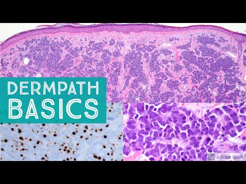 Basic Dermpath Cases  - Explained by a Dermatopathologist