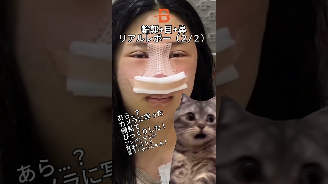 ビフォーアフター┃輪郭＋鼻＋目┃垢抜けたイメージを目指した彼女の１年間のダウンタイム♥┃ブラウン整形外科┃#韓国 #渡韓 #美容 #美容整形 #垢抜け #ダウンタイム #整形 #イメージ #鼻整形